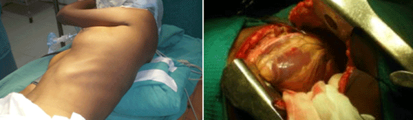 How to do it : Closed mitral commissurotomy