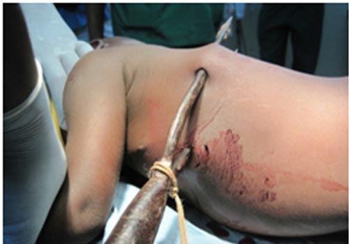 La plaie pénétrante thoracico-abdominale par harpon traditionel chez un enfant de 4 ans: Cas clinique